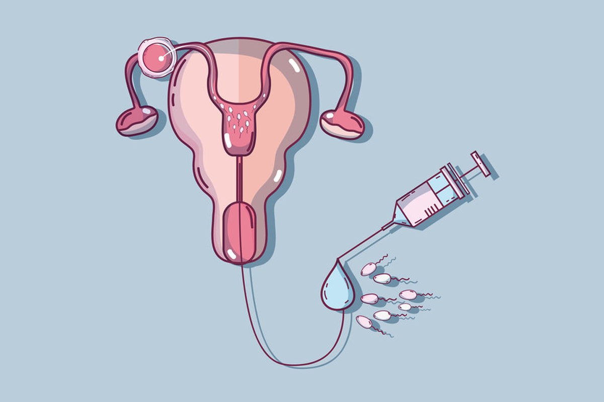 процедура введения спермы в матку фото 115