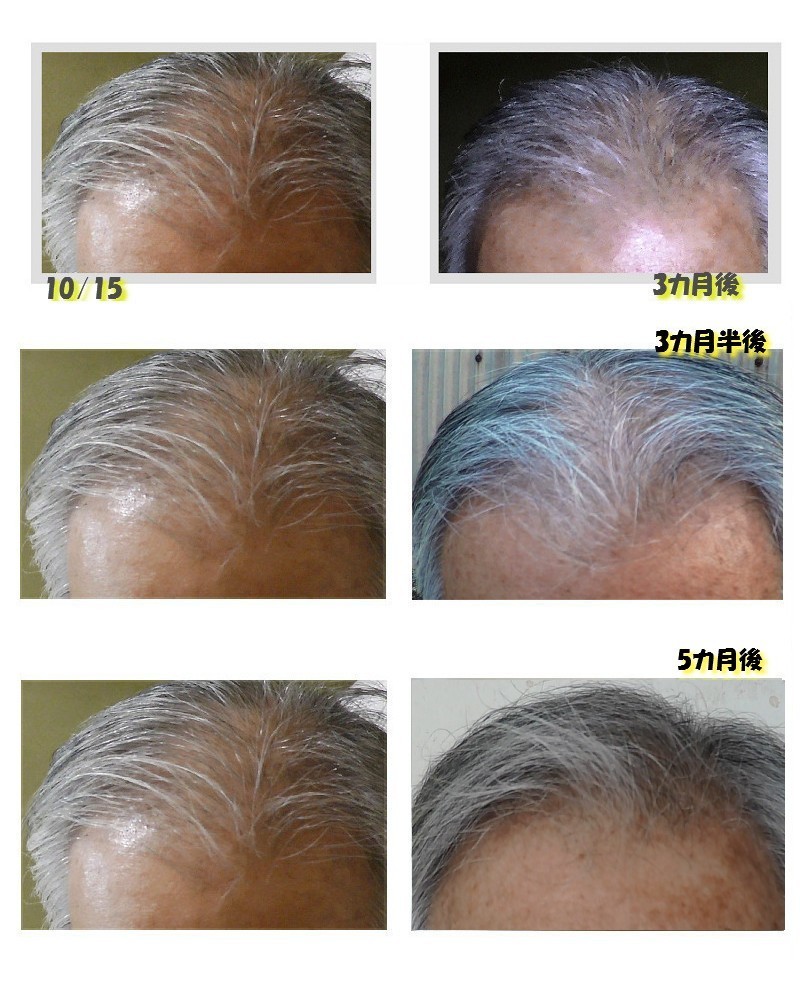 ハゲ対策 も5カ月目 Iq180 老人の 若返りダイエット 日記 ハゲ対策 も5カ月目 Iq180 老人の 若返りダイエット 日記