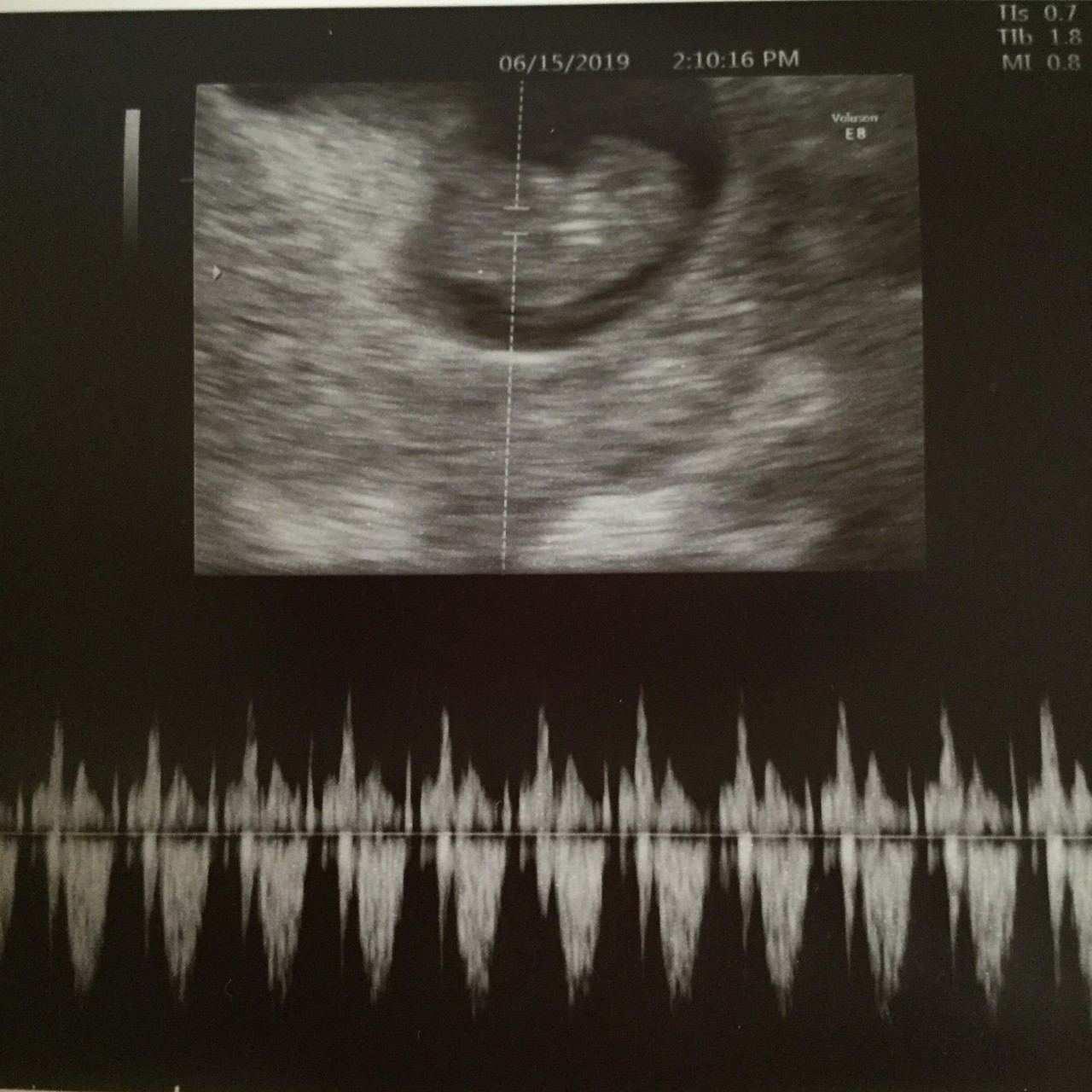 エコー 写真 見方 エコー写真の見方完全版 Flやbpdなど用語や数値の見方など徹底解説