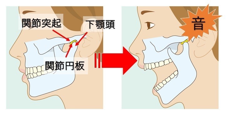 顎 が ずれ た 治し 方