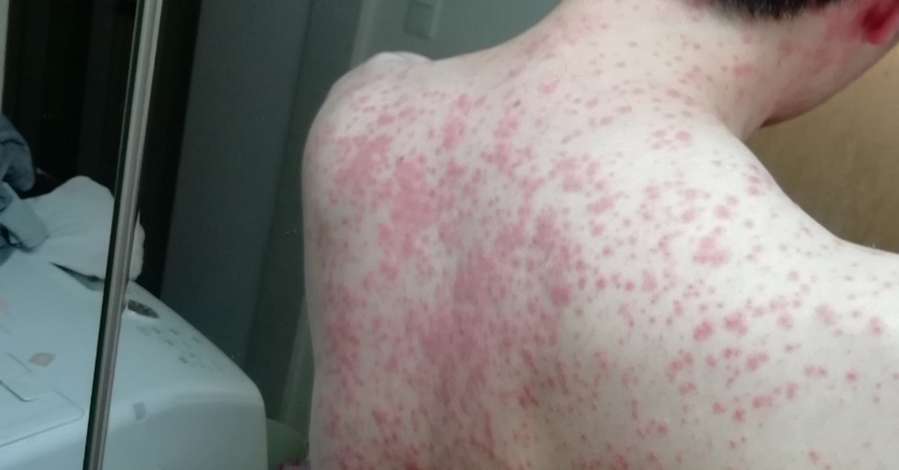 Hyperpoom Infection ピロリ菌陽性→除菌→発熱→発疹(今ココ)|MBA損保マン@兼業YouTuber|note