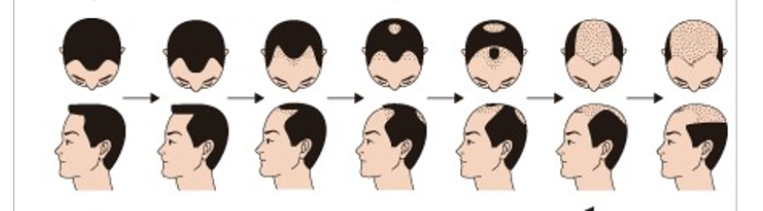 画像あり 気のせいか分かるm字ハゲの基準とは 東京 吉祥寺の薄毛 ハゲ Aga治療院 髪ワザchannel Note