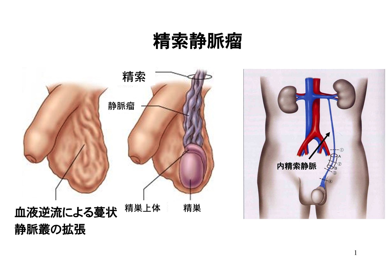 精索静脈瘤の手術を受けた体験談 精索静脈瘤くん Note