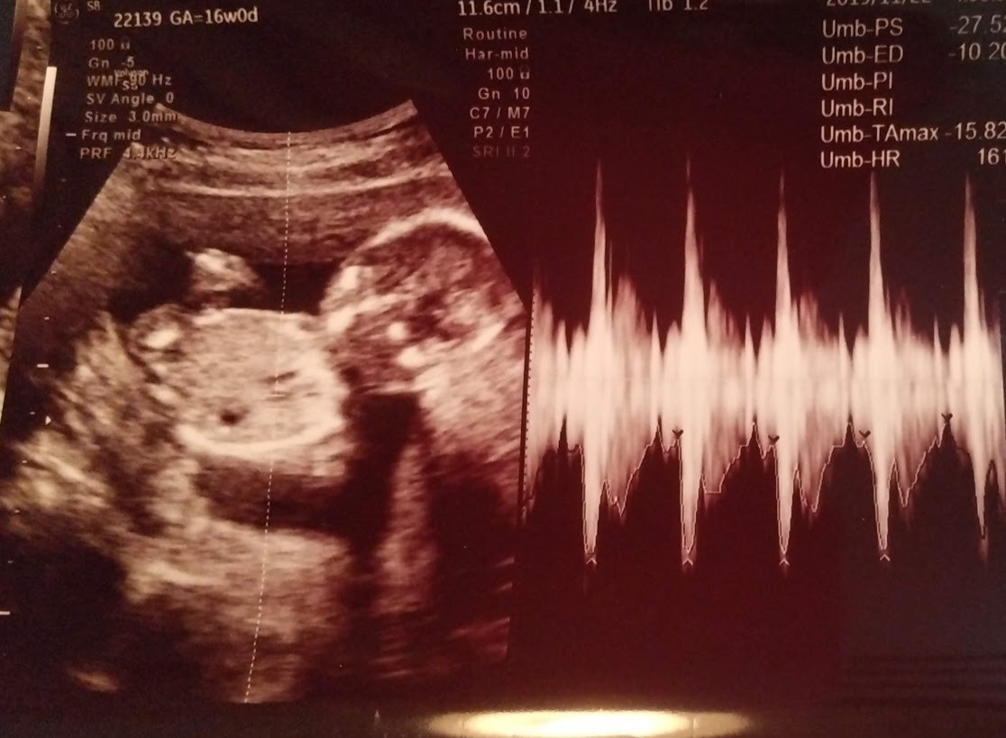 11 22 妊婦健診 4回目 赤ちゃんの性別が判明 アイス Note