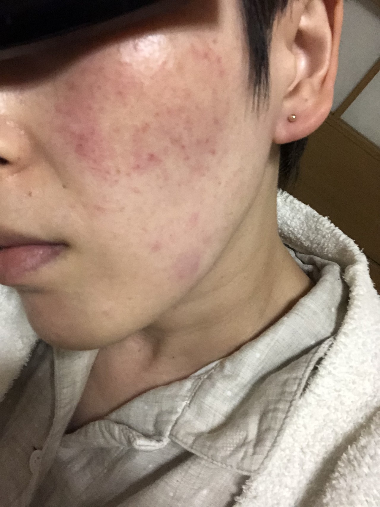 様 酒 皮膚 炎 さ