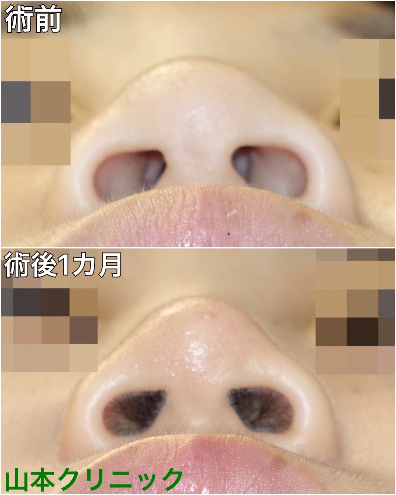 鼻を高くする手術 新宿 山本クリニック Note