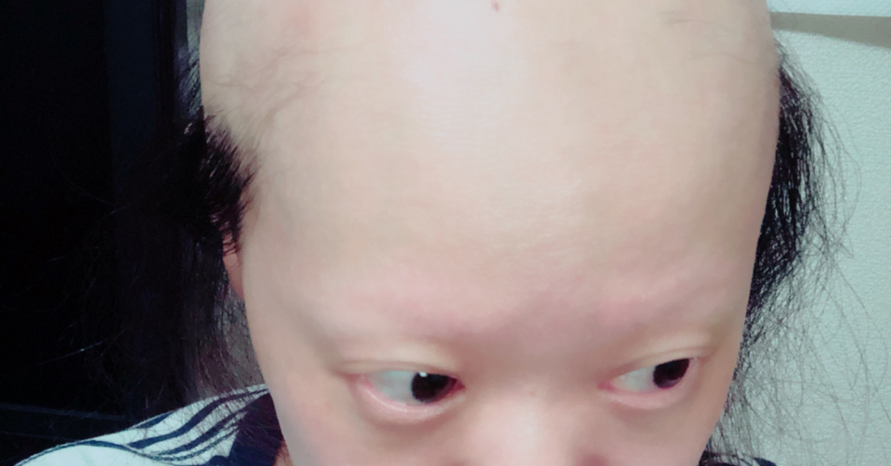 全身脱毛症になった自分の話｜にこ｜note