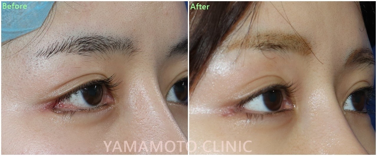 目尻切開のやりすぎ注意 新宿 山本クリニック Note