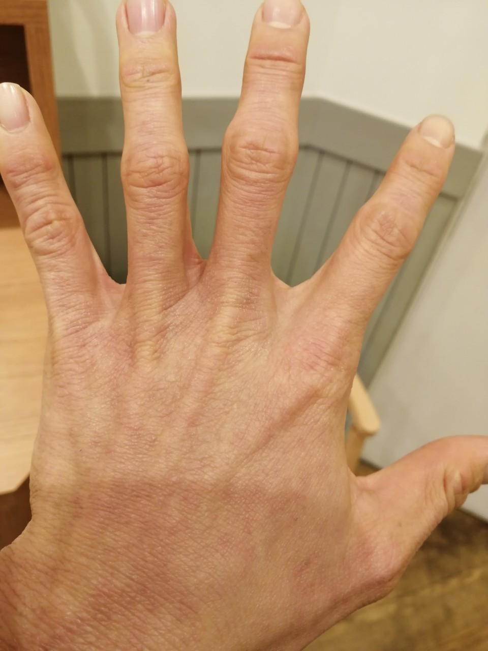 アトピー日記 132日目 眉間が死ぬほどかゆい アトピーマン Note