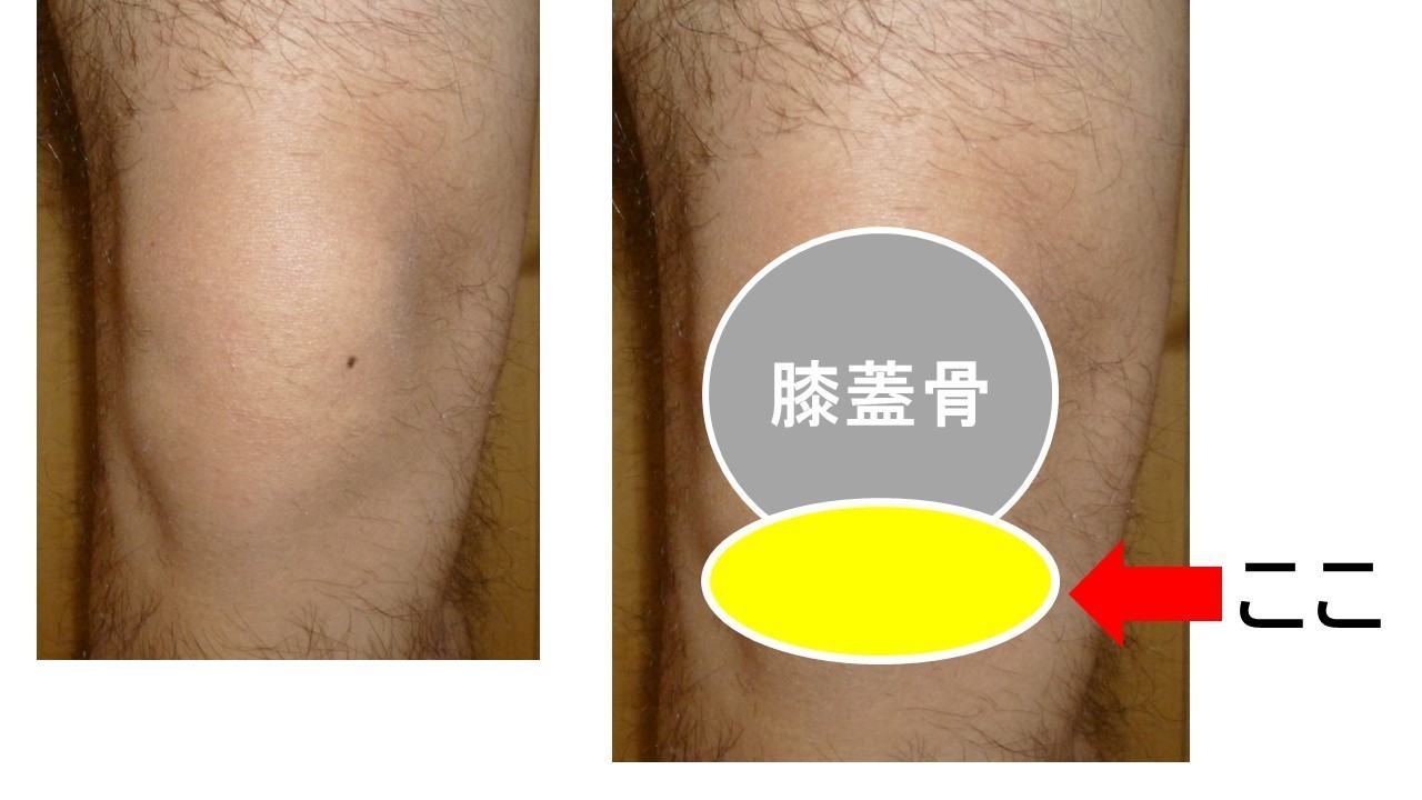 膝痛や可動域制限の原因！膝蓋下脂肪体の評価～アプローチまで解説｜おっしー＠理学療法士note｜note