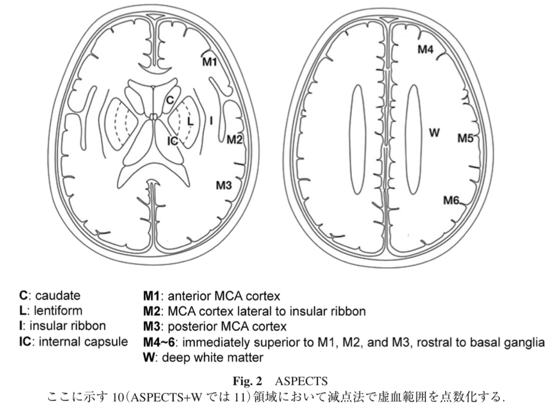 脳梗塞の評価。ASPECTをやりなよ。｜ぶーちん｜note