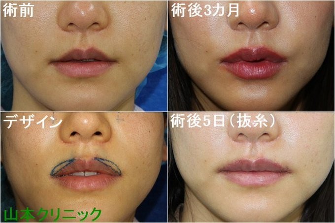 唇を厚くして人中を短く見せる 新宿 山本クリニック Note
