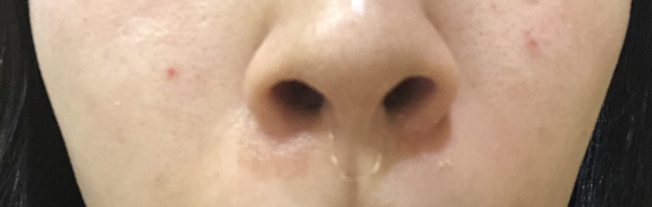 レチノールピール体験レポート Bisco Note