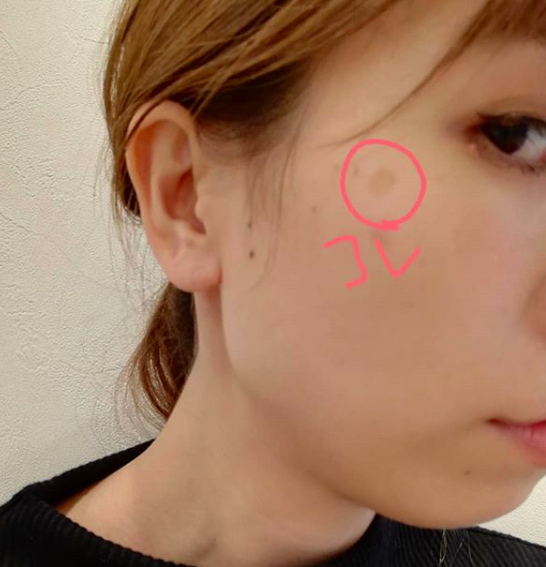 初体験日記 シミ ほくろ取り まいにちyukalog Note Ver Note