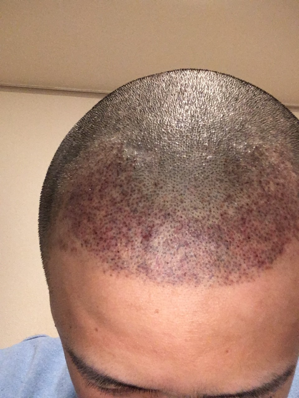 ヘアタトゥーで僕のように50万無駄にする前にお読み下さい ヘアタトゥーを検討中のあなたへ はっとり Note