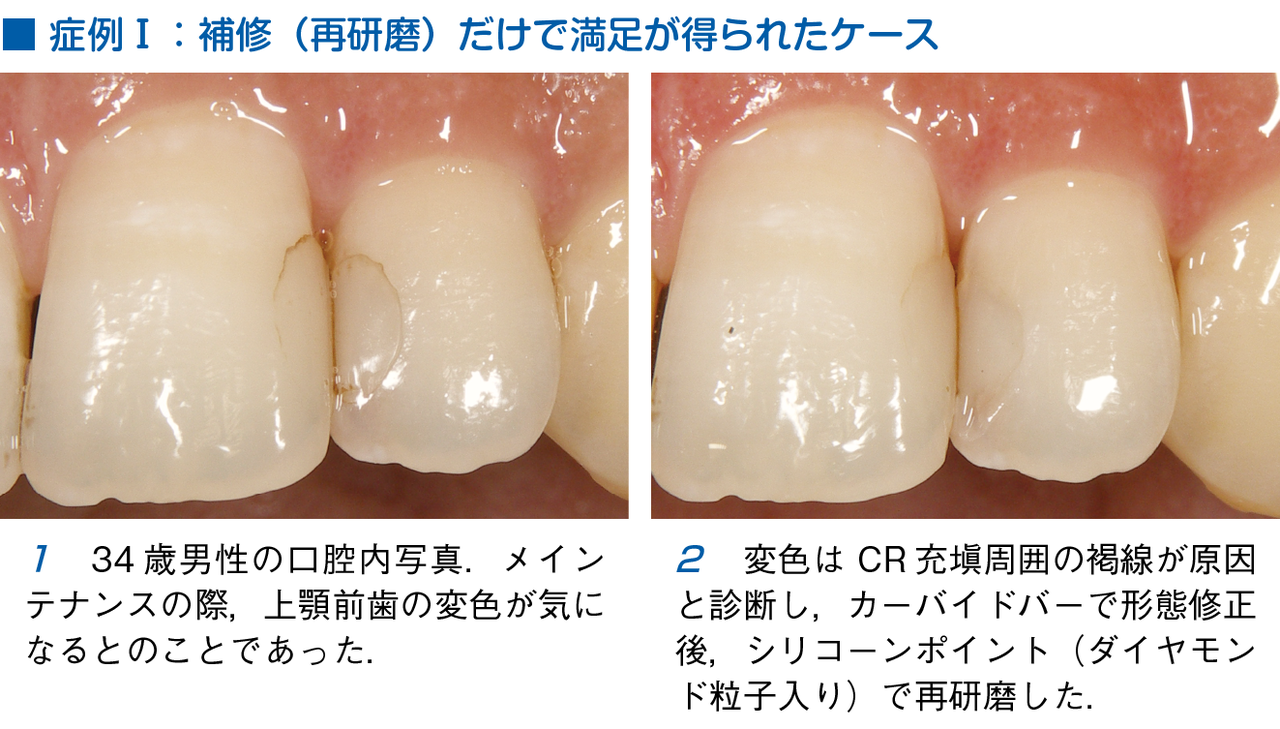 須崎 明 著 そうだったのか Cr修復 より 見て見ぬふりしたいマージンの褐線 月刊 日本歯科評論 編集部 ヒョーロン パブリッシャーズ Note