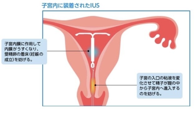 最大5年の避妊効果 子宮内避妊具iusとiudについて 考える Note
