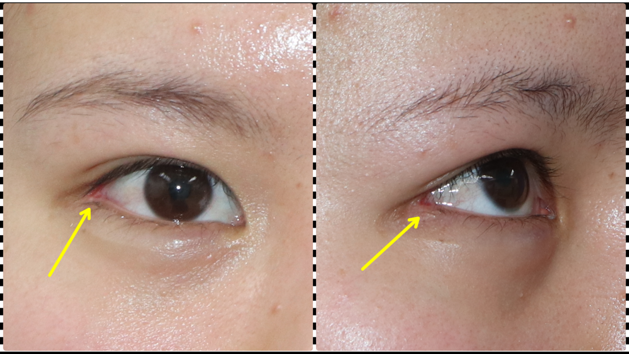 切りすぎた目尻は治せるの 新宿 山本クリニック Note