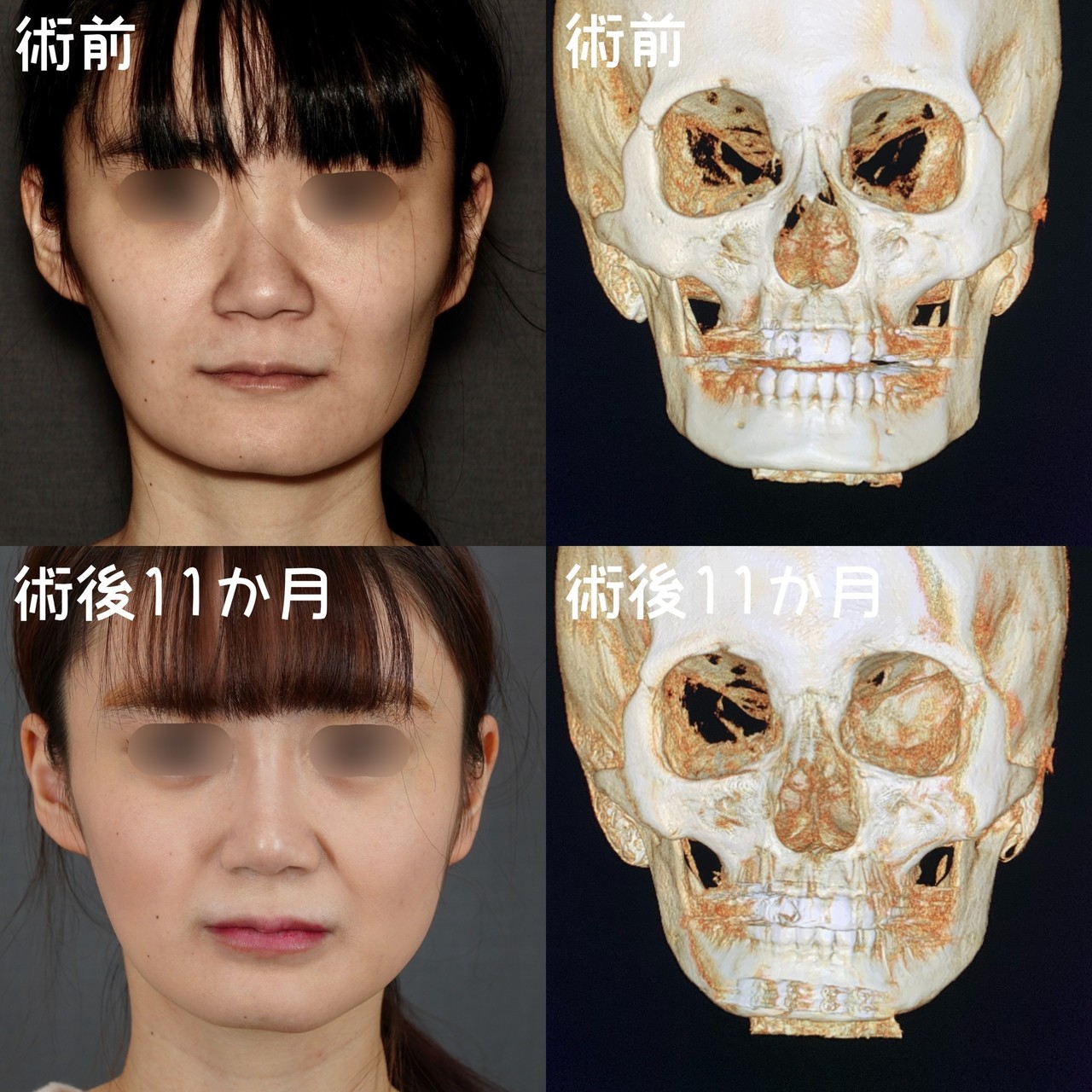 角張ったフェイスラインからの小顔の作り方 骨切りドクター宮崎 Note