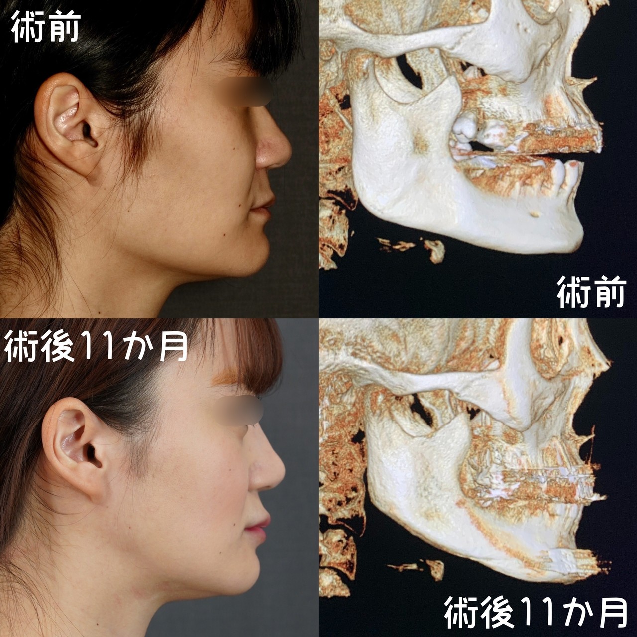 角張ったフェイスラインからの小顔の作り方 骨切りドクター宮崎 Note