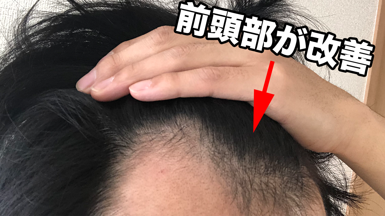 若 はげ 改善 若ハゲ 若年性脱毛症 の原因と 今やるべき対策 若 はげ 改善 若ハゲ 若年性脱毛症 の原因と 今やるべき対策