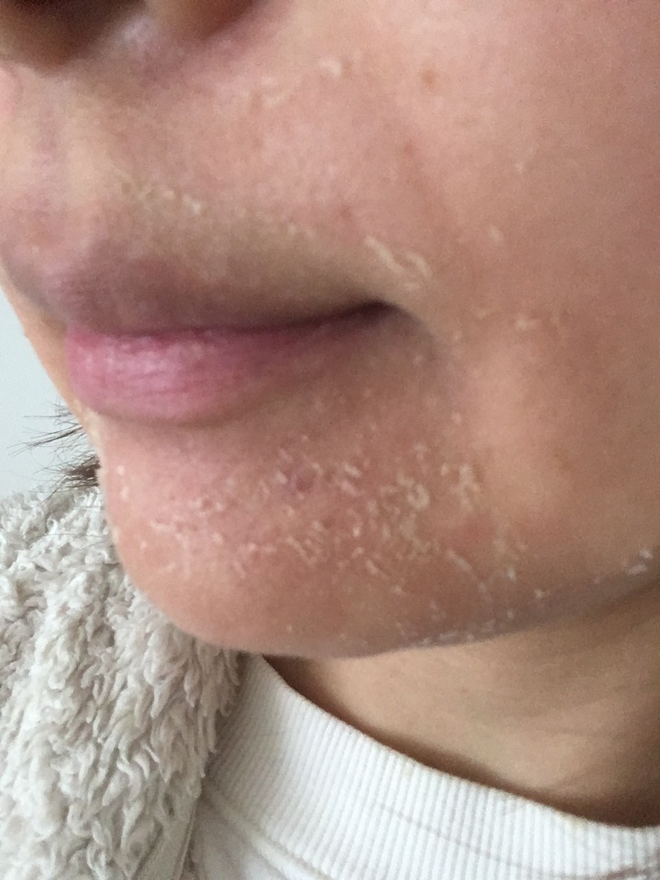 顔 かわ むける 乾燥肌さん向け 顔の皮がむける原因と綺麗肌になるための対策とは