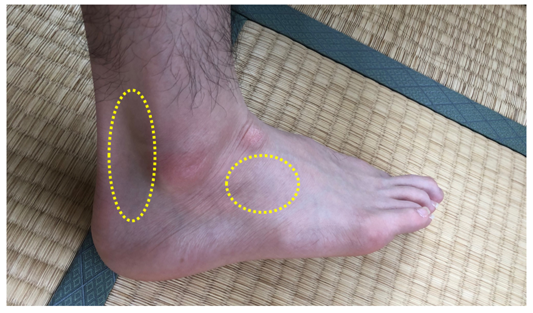 腓骨筋の病態(腱炎と脱臼)について考える!|Y.K|note 腓骨筋の病態(腱炎と脱臼)について考える!|Y.K|note