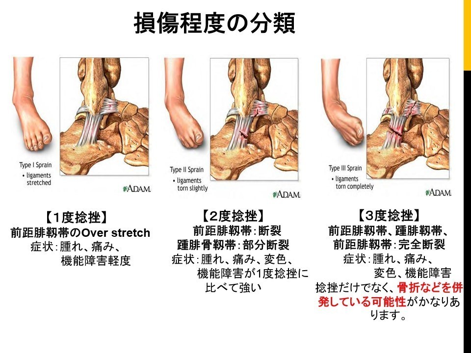 足関節捻挫の鑑別チェックポイント｜骨次郎｜note