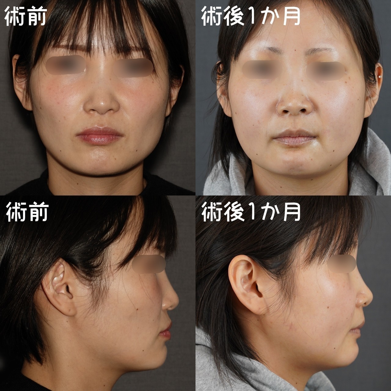 口元 Vラインを同時に整える 骨切りドクター宮崎 Note