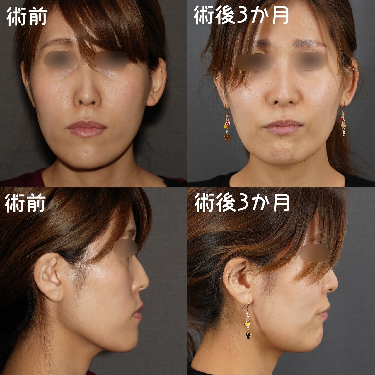 面長を変える 骨切りドクター宮崎 Note