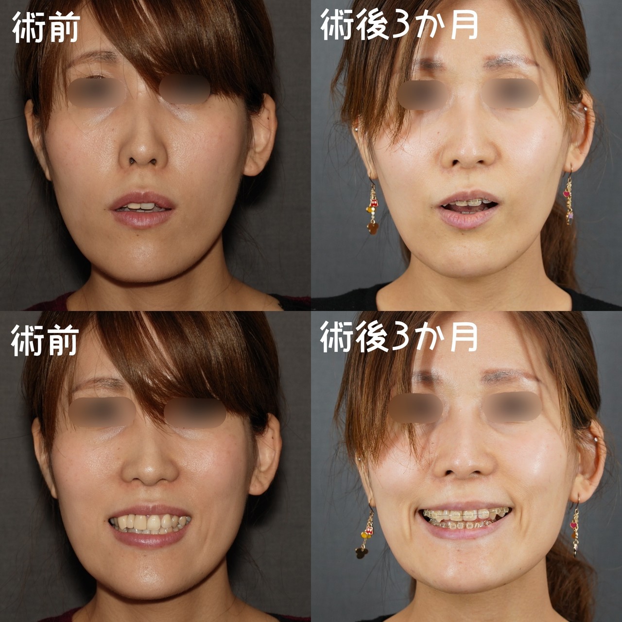 面長を変える 骨切りドクター宮崎 Note