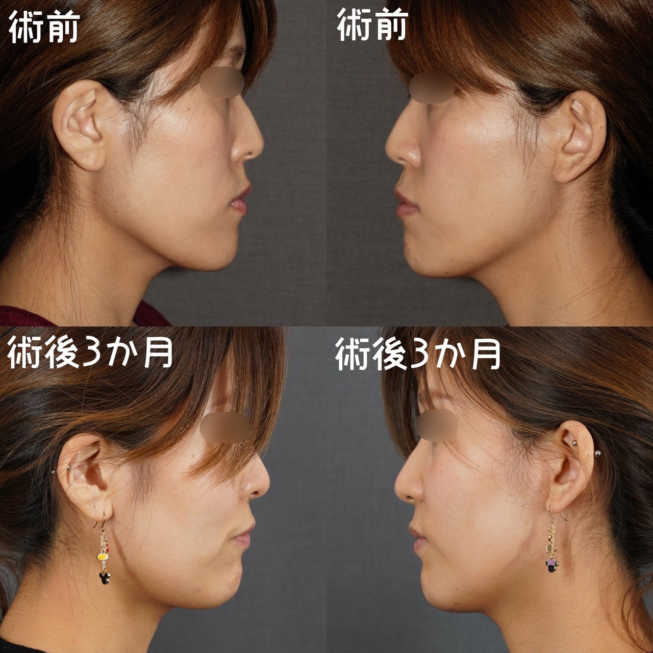 面長を変える 骨切りドクター宮崎 Note