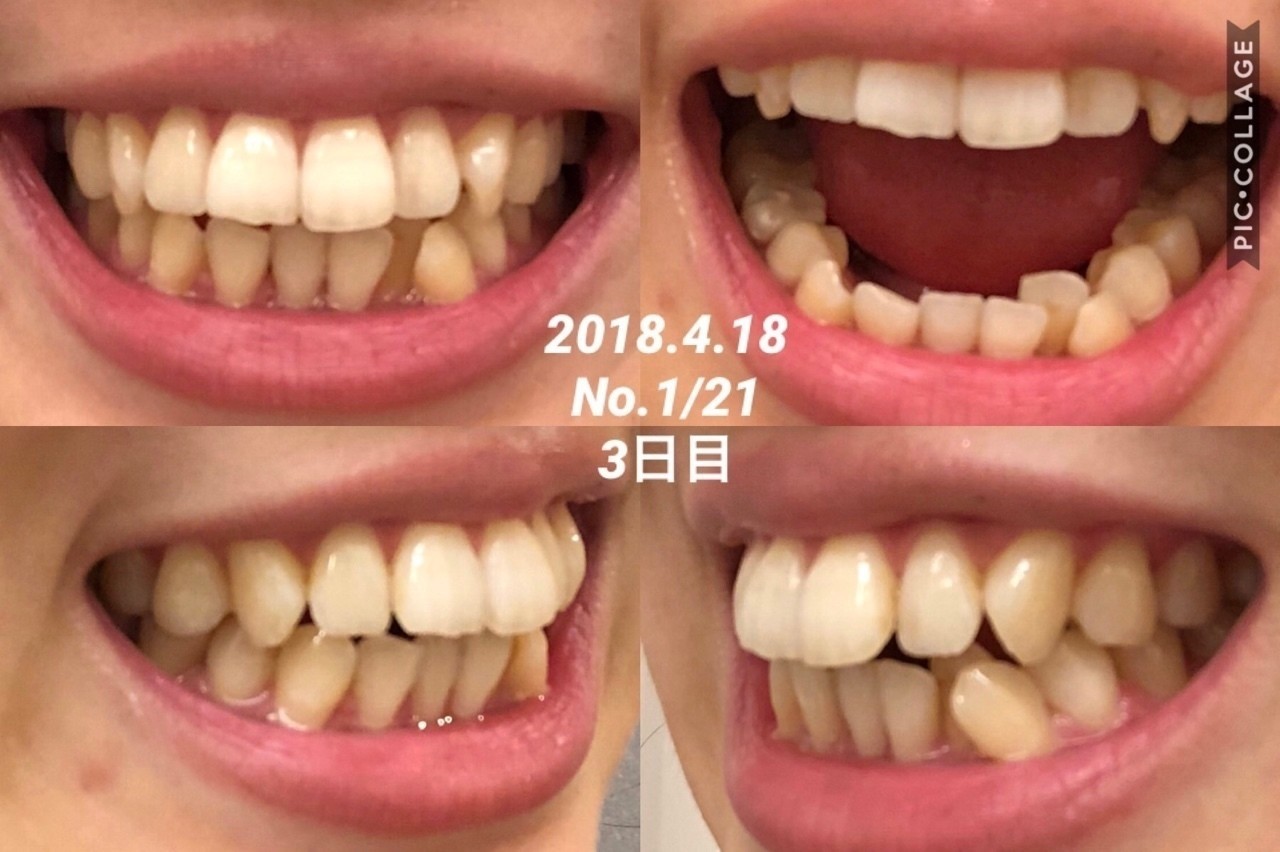 チューイー アライナー