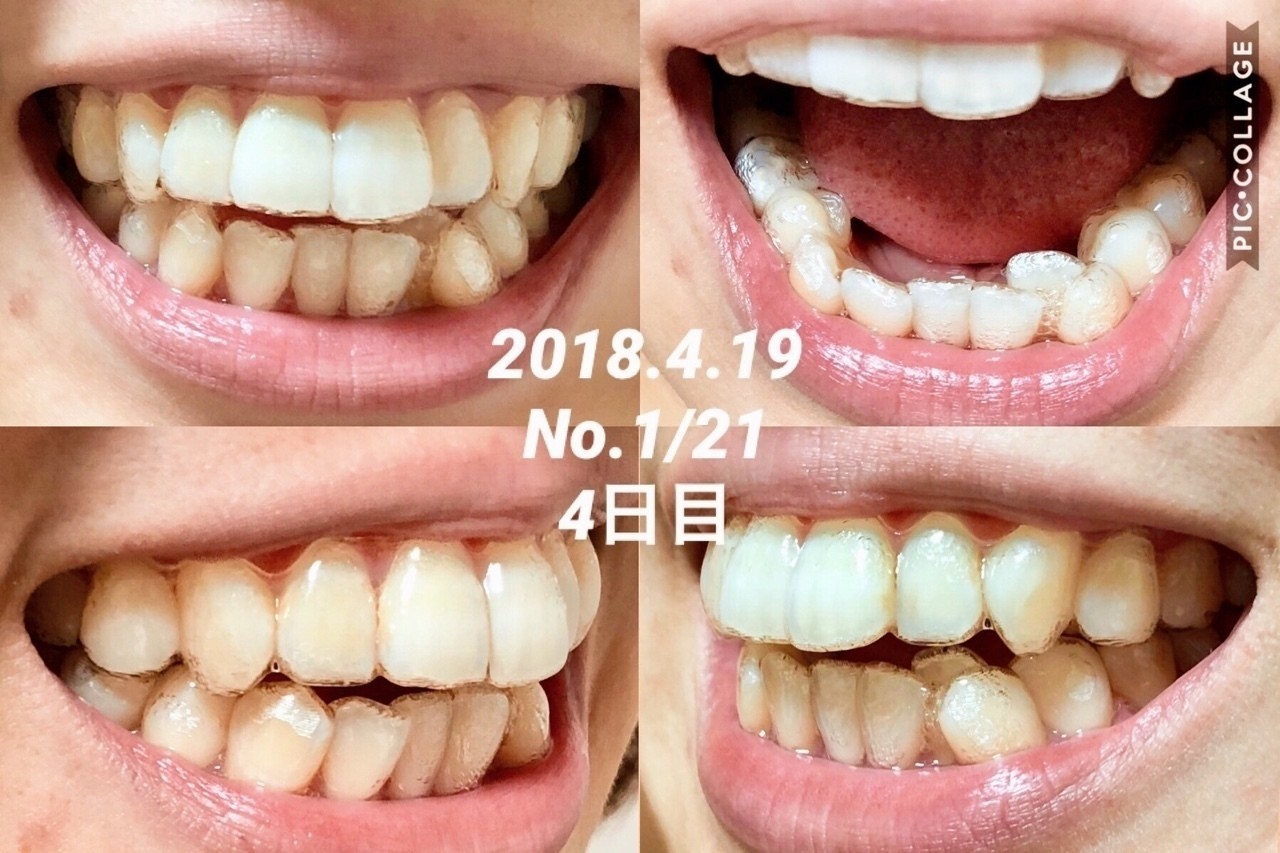 チューイー アライナー