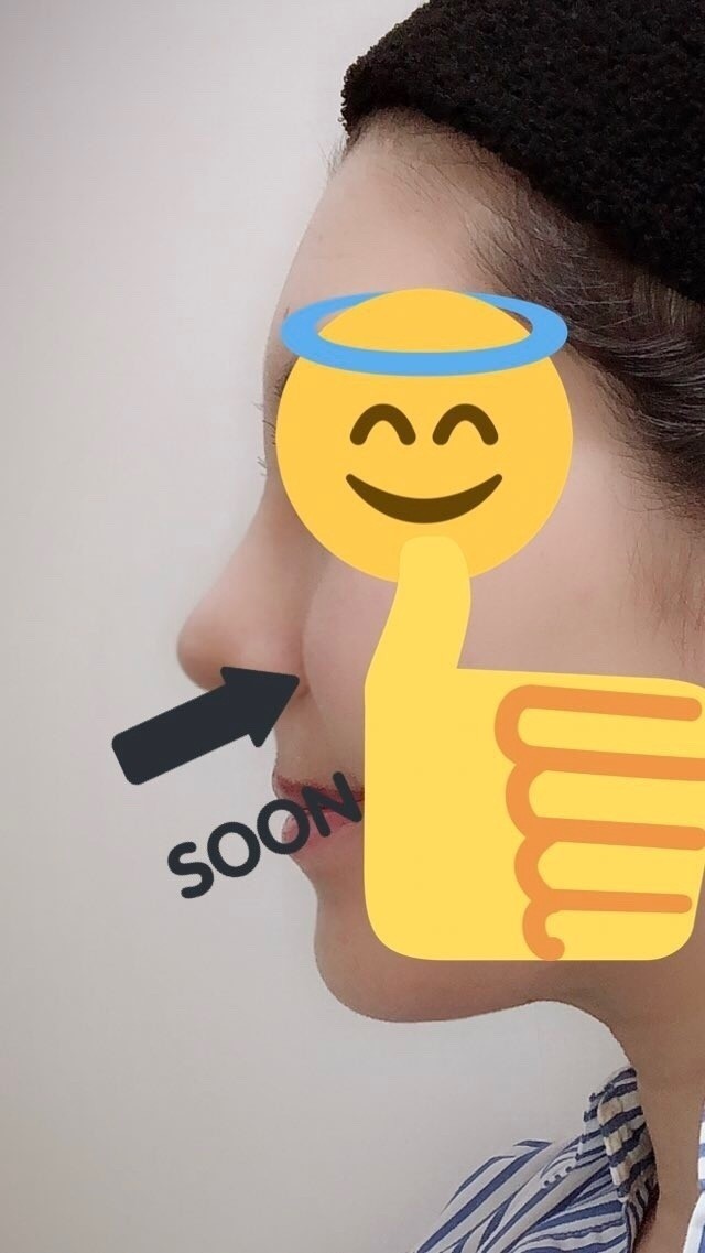 鼻の横から伸びる線 ほうれい線 を消す 鼻翼基部手術 貴族手術 カウセレポート はげまして成宮 Note