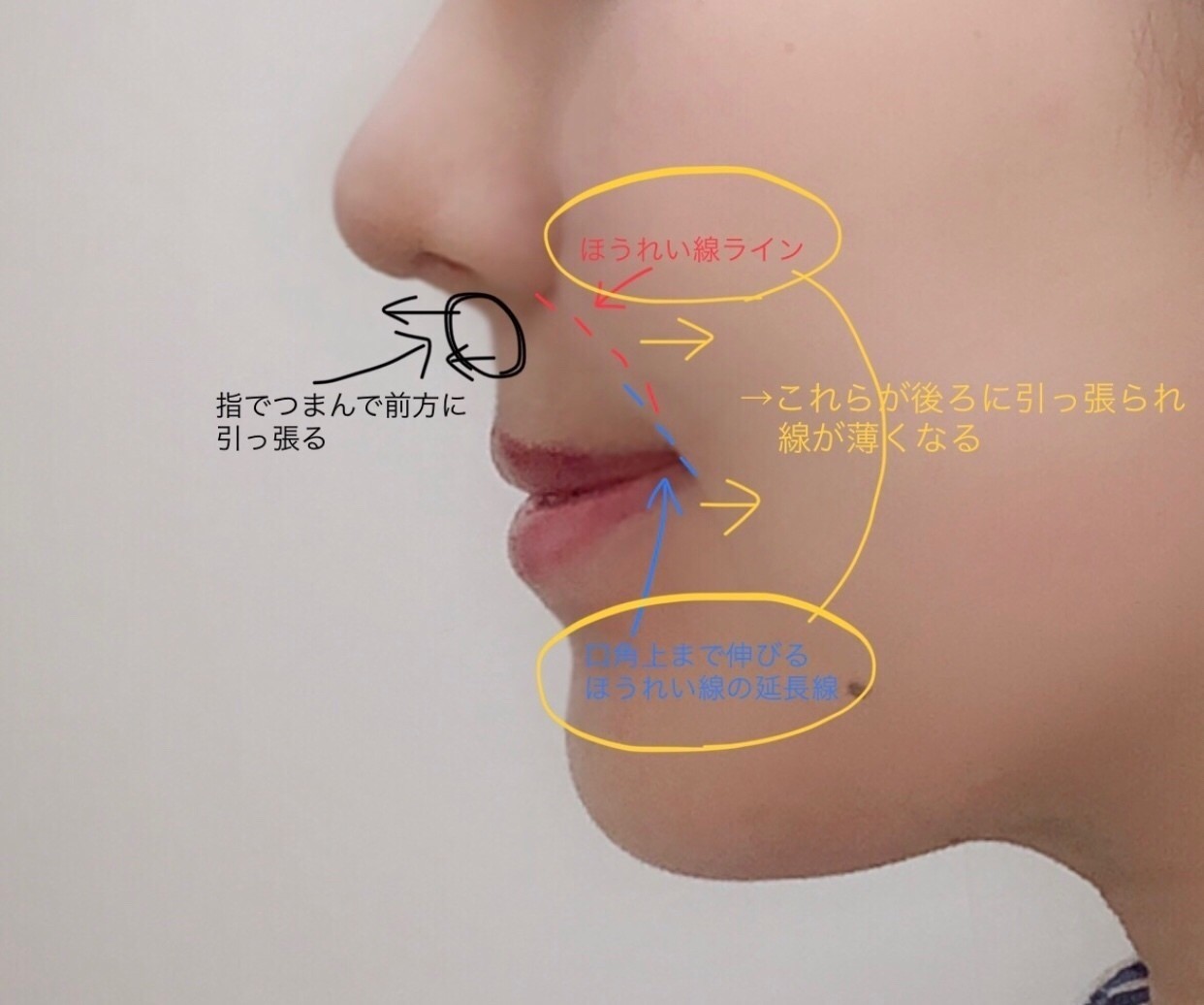 鼻の横から伸びる線 ほうれい線 を消す 鼻翼基部手術 貴族手術 カウセレポート はげまして成宮 Note